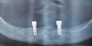 Marginal Bone Remodeling  