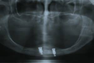 Overdentures and PROMS