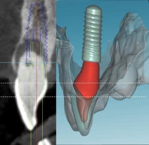 Immediate in the aesthetic zone